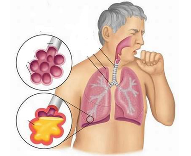 Dược thiện tăng cường miễn dịch cho người bị viêm nhiễm đường hô hấp